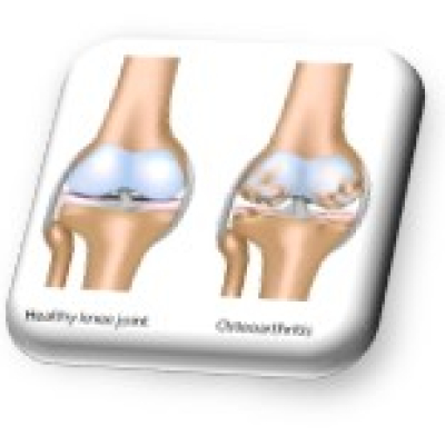 Knee osteoarthritis